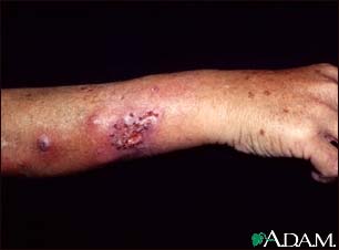 Sporotrichosis on the forearm Sporotrichosis on the forearm