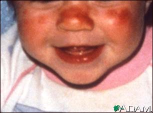 Lupus, discoid on the face Lupus, discoid on the face