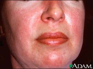Dermatomyositis, heliotrope rash on the face Dermatomyositis, heliotrope rash on the face