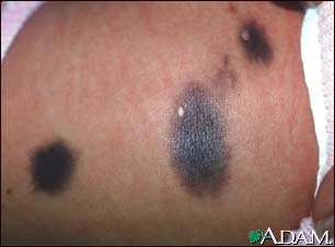 Congenital nevus on the abdomen Congenital nevus on the abdomen