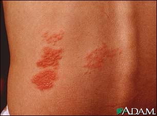 Herpes zoster (shingles) on the back Herpes zoster (shingles) on the back