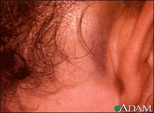 Battle's sign - behind the ear Battle's sign - behind the ear