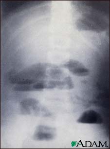 Small bowel obstruction - X-ray Small bowel obstruction - X-ray