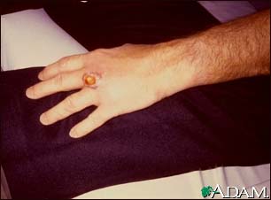 Brown recluse spider bite on the hand Brown recluse spider bite on the hand