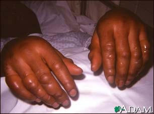 Frostbite - hands Frostbite - hands