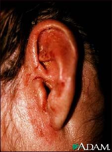Tinea corporis - ear