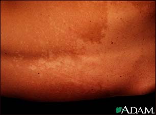 Tinea versicolor - back Tinea versicolor - back