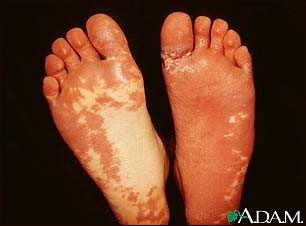 Sturge-Weber syndrome - soles of feet Sturge-Weber syndrome - soles of feet