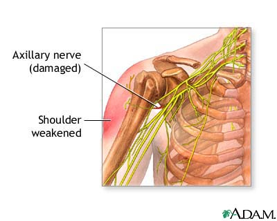 Damaged axillary nerve Damaged axillary nerve