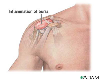 Bursitis of the shoulder Bursitis of the shoulder