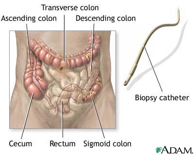 Colonoscopy Colonoscopy