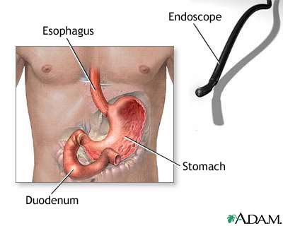 Gastric endoscopy Gastric endoscopy