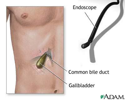 Gallbladder endoscopy Gallbladder endoscopy