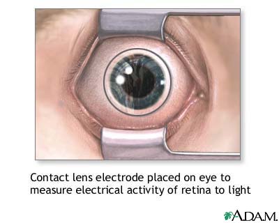 Contact lens electrode on eye Contact lens electrode on eye