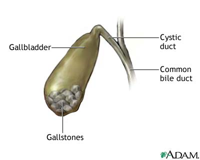 Gallstones Gallstones