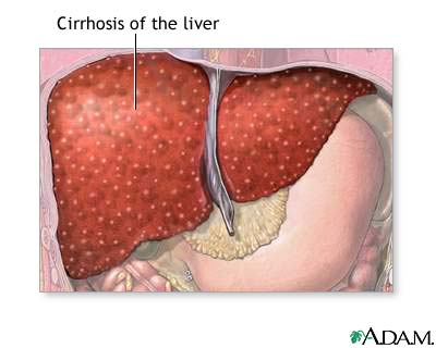 Cirrhosis of the liver Cirrhosis of the liver