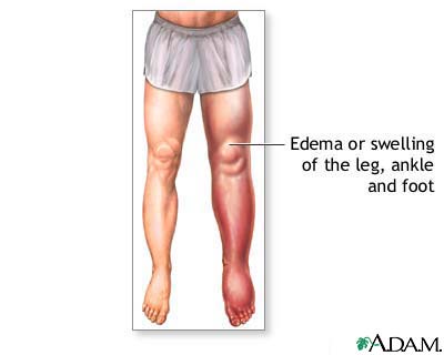 Lower leg edema Lower leg edema