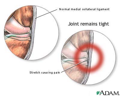 Medial collateral ligament pain Medial collateral ligament pain