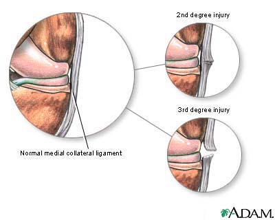 Medial collateral ligament injury Medial collateral ligament injury