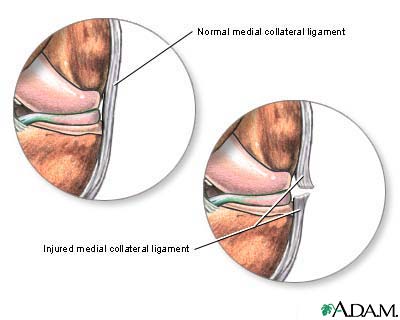 Torn medial collateral ligament Torn medial collateral ligament