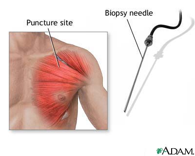 Muscle biopsy Muscle biopsy