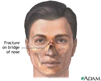Nasal fracture Nasal fracture
