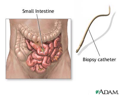 Small intestine biopsy Small intestine biopsy