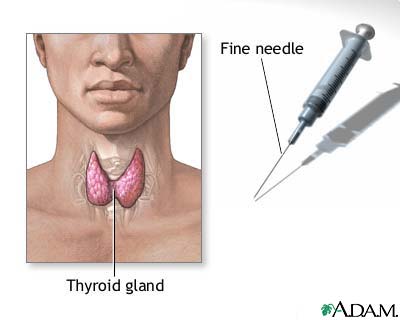Thyroid gland biopsy Thyroid gland biopsy