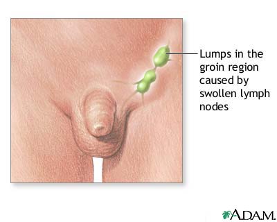 Swollen lymph nodes in the groin Swollen lymph nodes in the groin