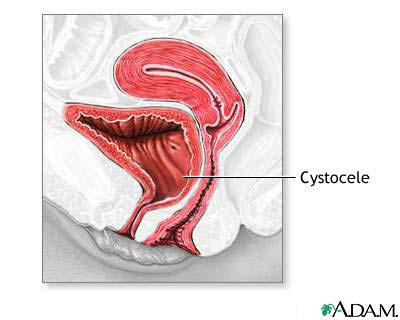 Cystocele Cystocele