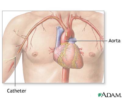 Cardiac arteriogram Cardiac arteriogram