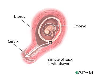 Chorionic villus sampling Chorionic villus sampling