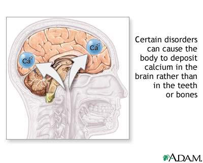 Cranial calcification Cranial calcification