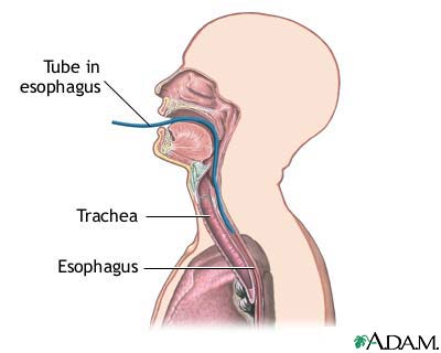 Esophageal pH monitoring Esophageal pH monitoring
