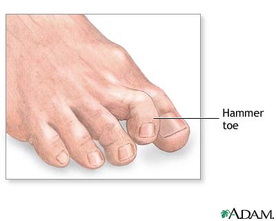 Hammer toe Hammer toe
