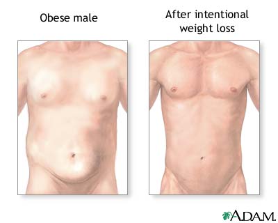 Weight loss Weight loss