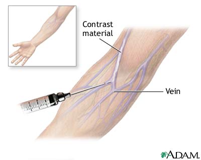 Intravenous pyelogram Intravenous pyelogram