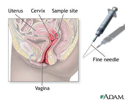 Cervix needle sample Cervix needle sample