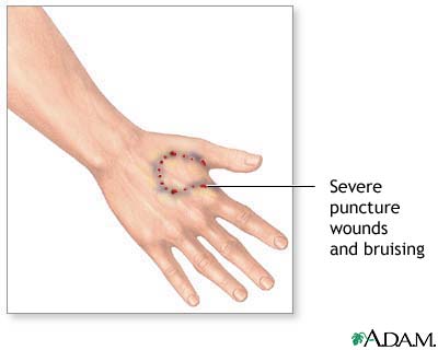 Animal bite Animal bite