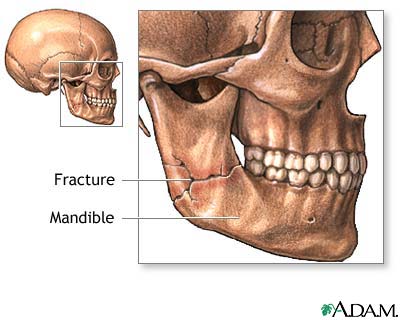 Mandibular fracture Mandibular fracture