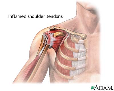 Inflamed shoulder tendons Inflamed shoulder tendons