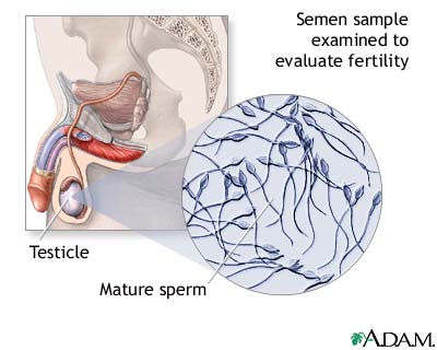 Semen analysis Semen analysis