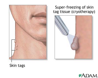 Skin tag Skin tag