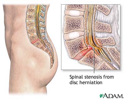 Spinal stenosis Spinal stenosis