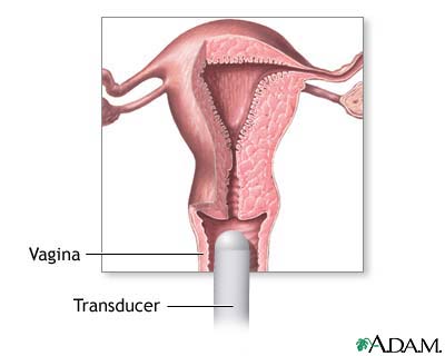Transvaginal ultrasound Transvaginal ultrasound