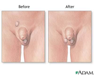 Before and after testicular repair Before and after testicular repair