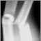 Fracture, forearm - X-ray