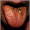 Black hairy tongue